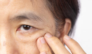 1-1. まぶたが開きにくくなる「眼瞼下垂」とは