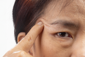 1-1. 眼瞼下垂の主な症状